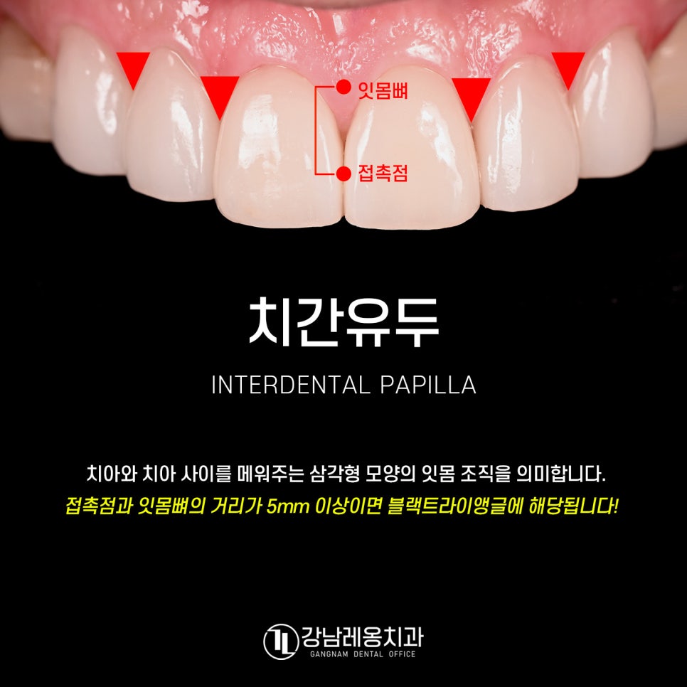 잇몸과 치아 사이 공간 &lsquo;블랙트라이앵글&rsquo;을 무시하면 안되는 이유! / 생기는 원인과 해결 방법 / 강남레옹치과 관련 이미지 2