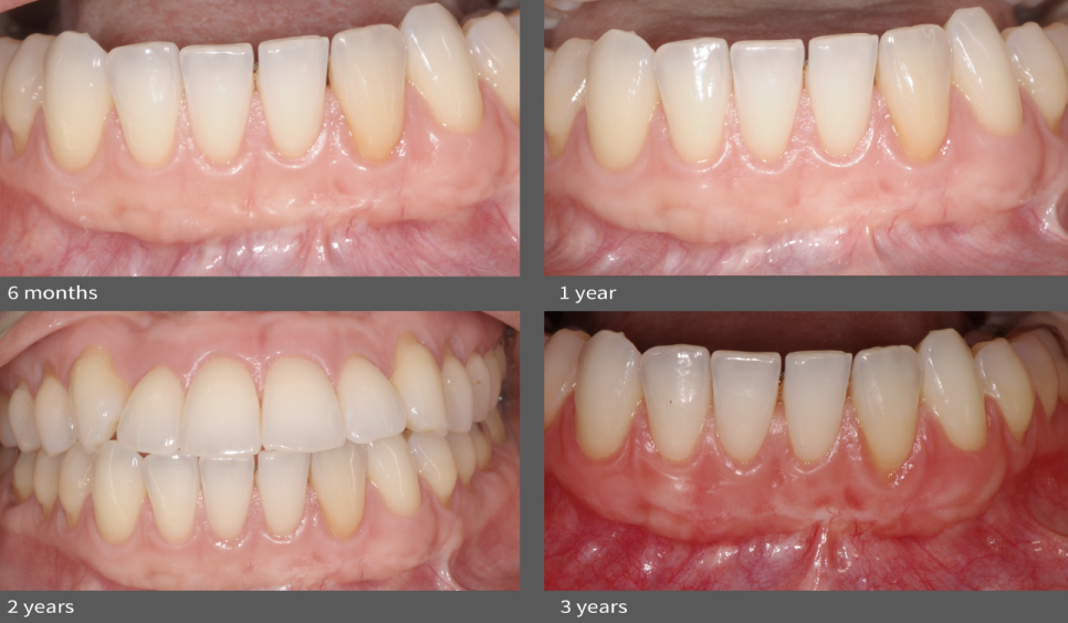 박영민 원장님의 논문! 치은이식 후 자연치아 주위 잇몸퇴축 감소에 관한 연구 관련 이미지 4