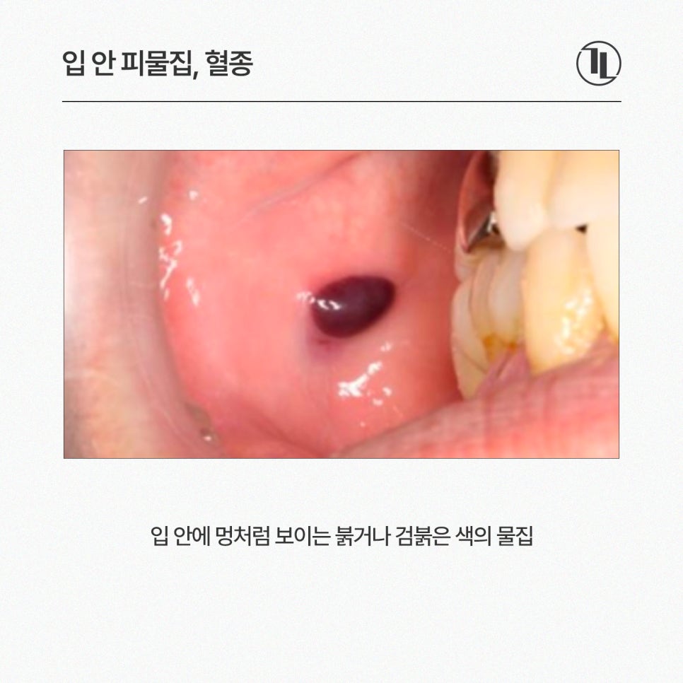 입안 피물집, 물혹, 혓바늘, 혀돌기(유두종) 원인 및 치료 / 강남레옹치과 관련 이미지 2