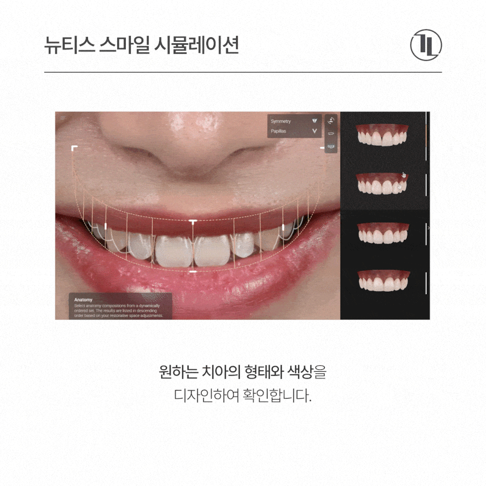 뉴티스 스마일 시뮬레이션 - 시술 전 영상으로 미리 확인하는 내 모습! / 강남레옹치과 관련 이미지 3