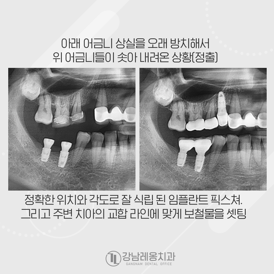 치조골 흡수, 심한 잇몸염증 있으면 임플란트 수술 가능할까? 관련 이미지 2