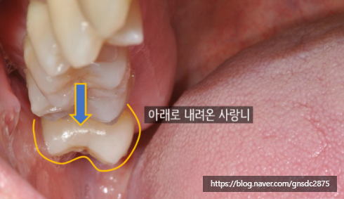 아래 사랑니만 발치해도 괜찮을까? 강남역 사랑니발치 /  강남레옹치과 관련 이미지 3