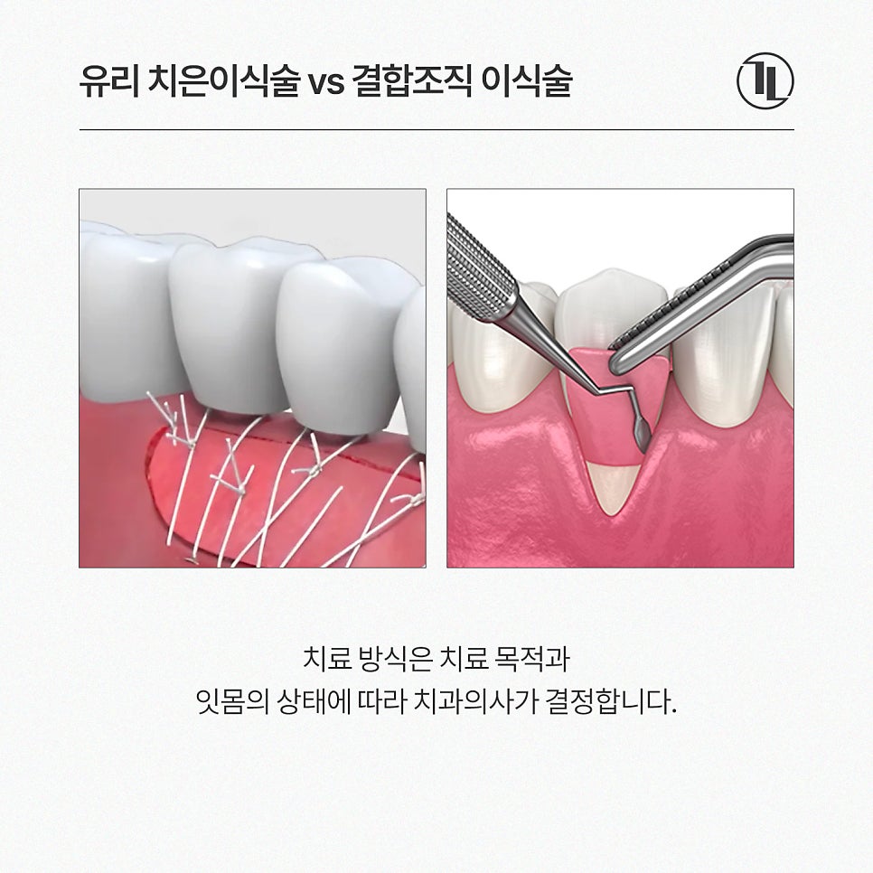 잇몸 내려앉음, 잇몸퇴축 잇몸이식으로 개선 / 강남레옹치과 관련 이미지 3