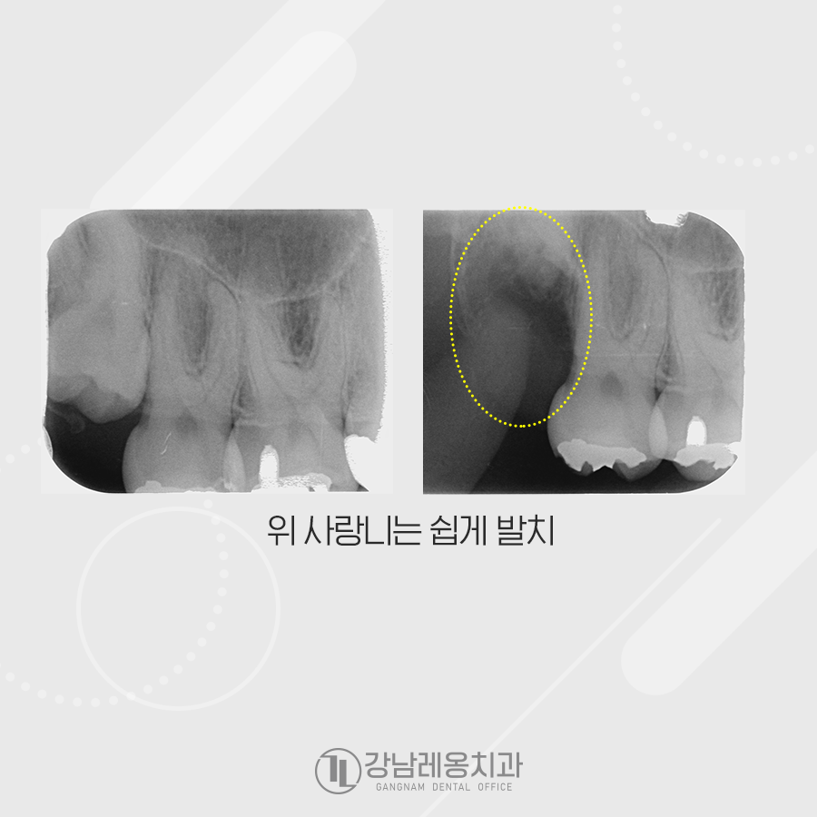 누운 사랑니 발치 통증 없이 깨끗하게 아물었던 강남레옹치과 증례 관련 이미지 3