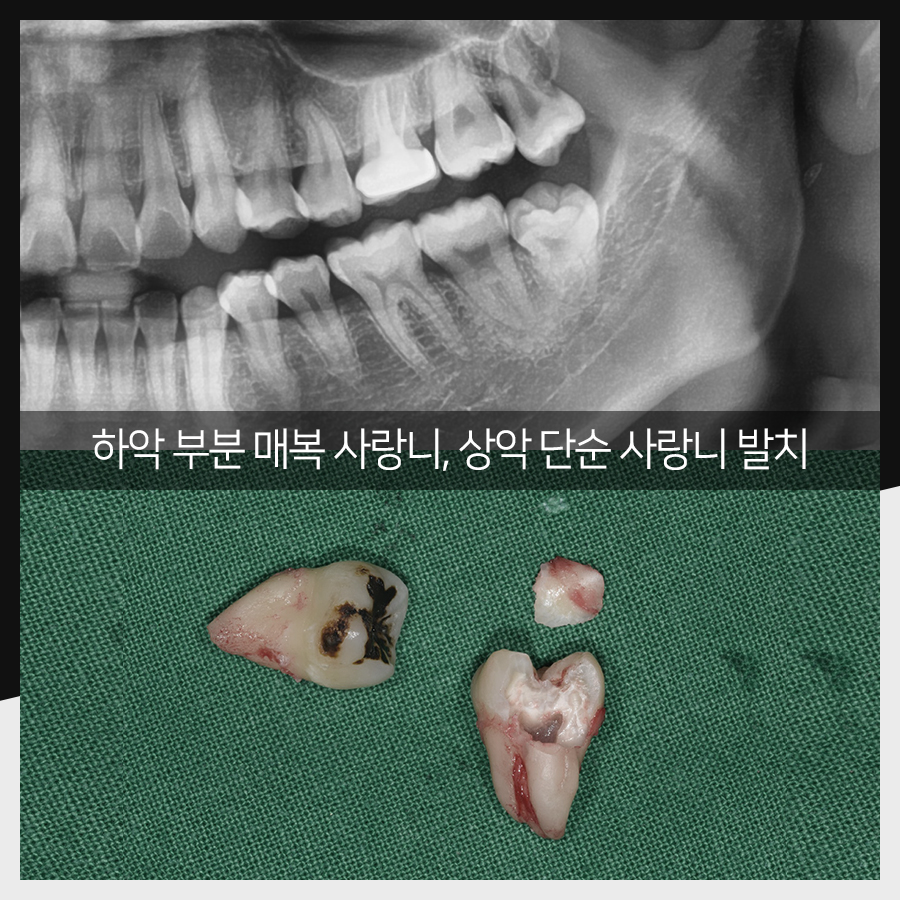 강남레옹치과 사랑니 발치, 결과가 증명해주는 실력! 관련 이미지 16