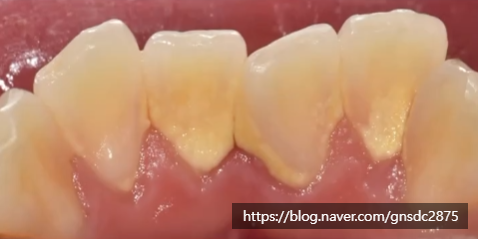 겨울철 구강관리, 스케일링 한 번으로 바뀌는 잇몸 상태❄️ / 강남레옹치과 관련 이미지 6