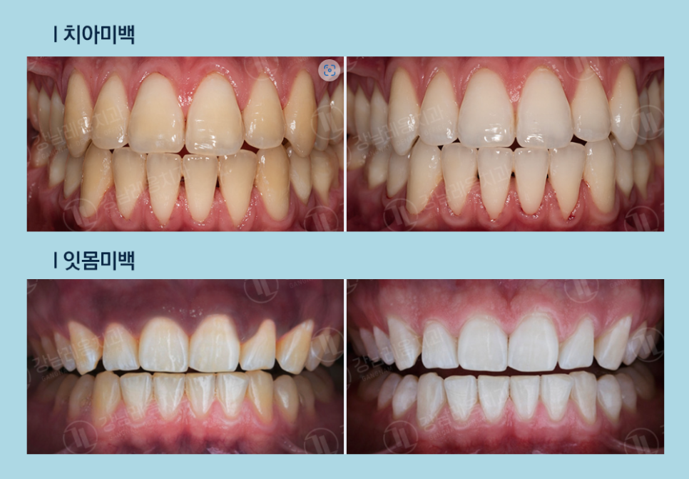 강남레옹치과 뉴티스, 라미네이트 말고도 예쁜 앞니 되찾는 법!? 관련 이미지 6