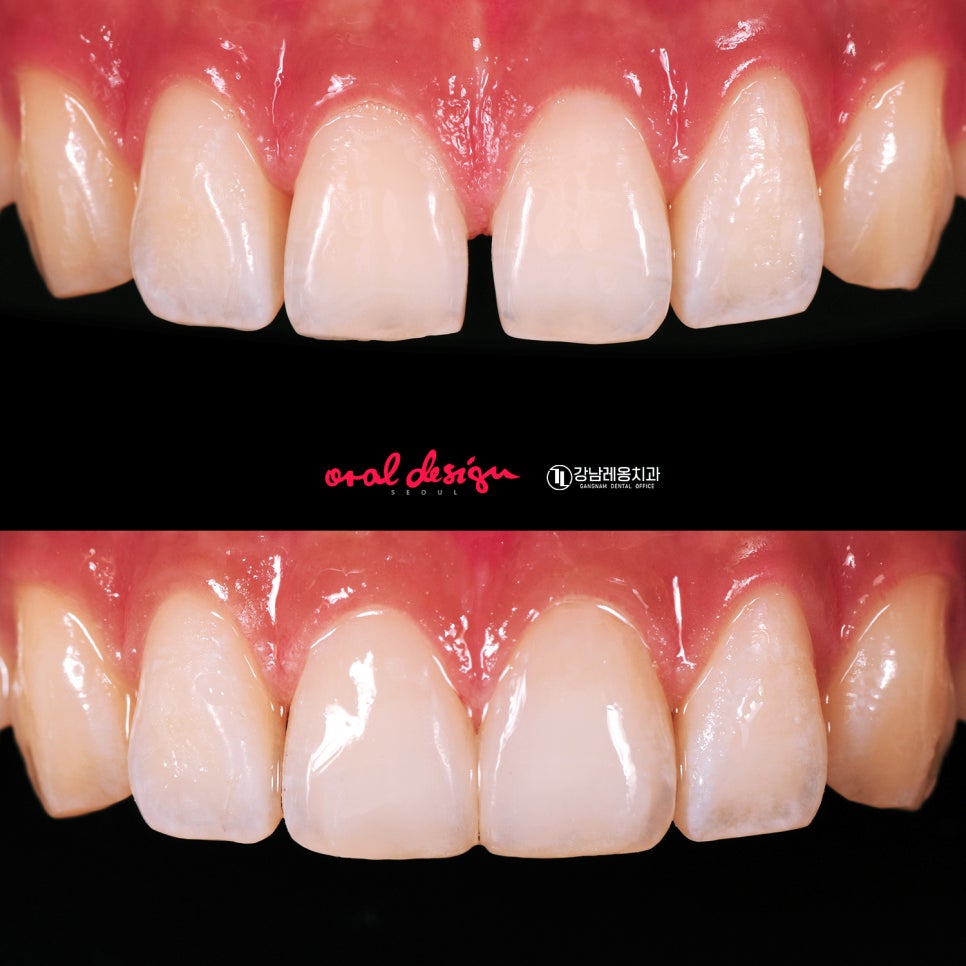 치아 벌어짐 / 앞니 사이 간격 넓어짐 / 정중이개 원인의 증상 그리고 개선할 수 있는 방법에 대해 관련 이미지 6