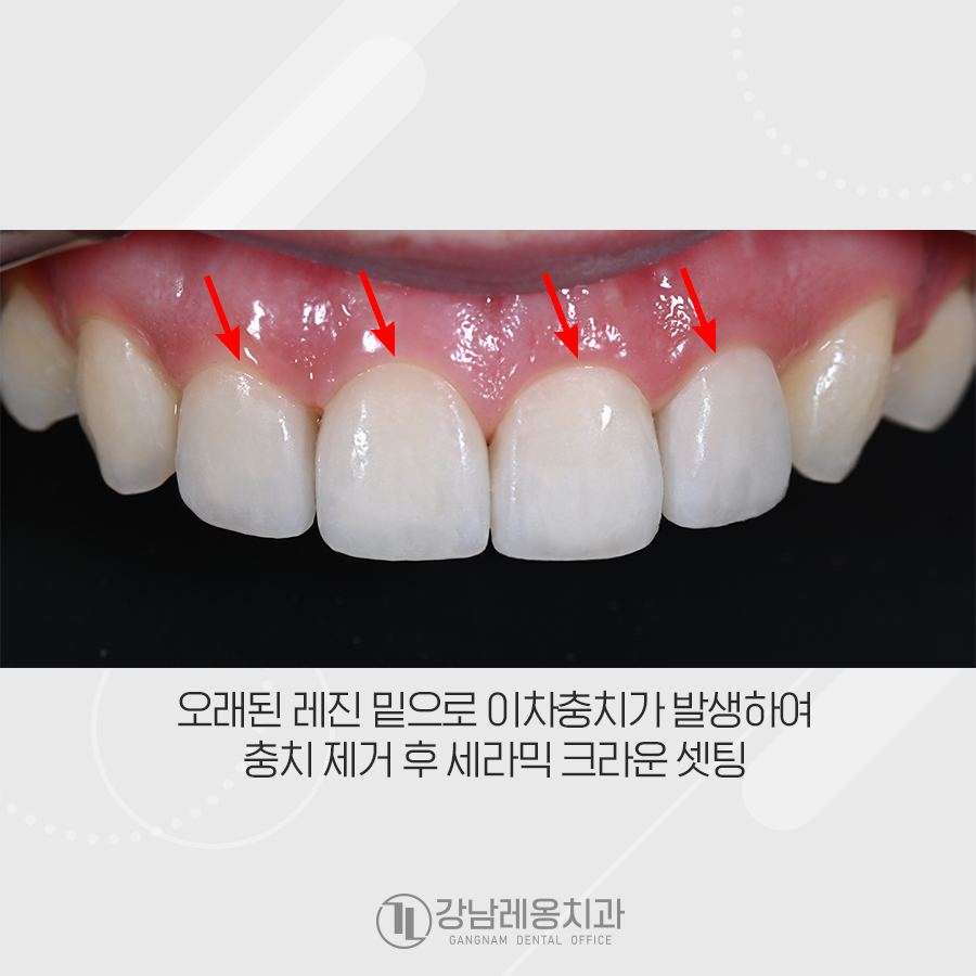오래된 레진 교체 앞니 크라운! 강남레옹치과의 오랄디자인으로 개선 관련 이미지 2