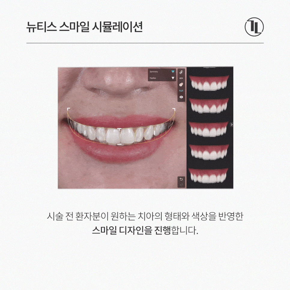뻐드러진 나비앞니, 시술 전 스마일 시뮬레이션 후 뉴티스라미 관련 이미지 3