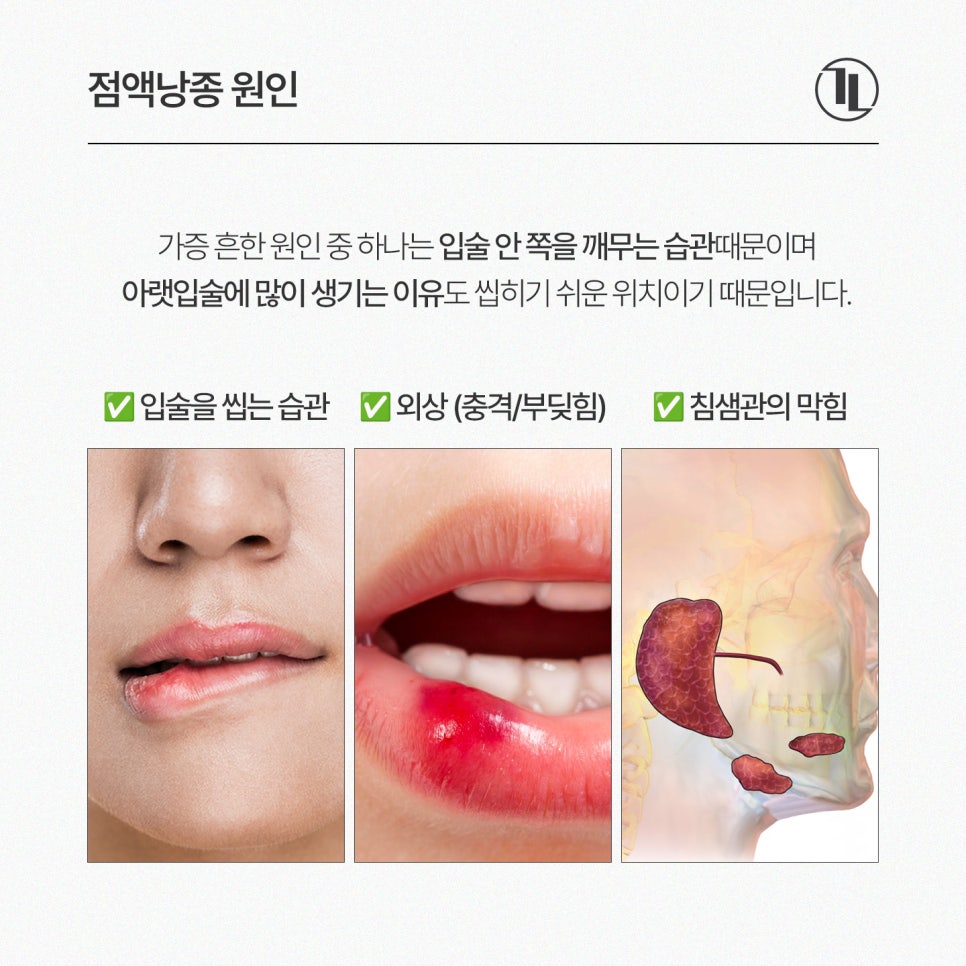 입술 안쪽에 말랑한 멍울, 그냥 둬도 괜찮을까? / 점액낭종 특징과 치료 / 강남레옹치과 관련 이미지 4