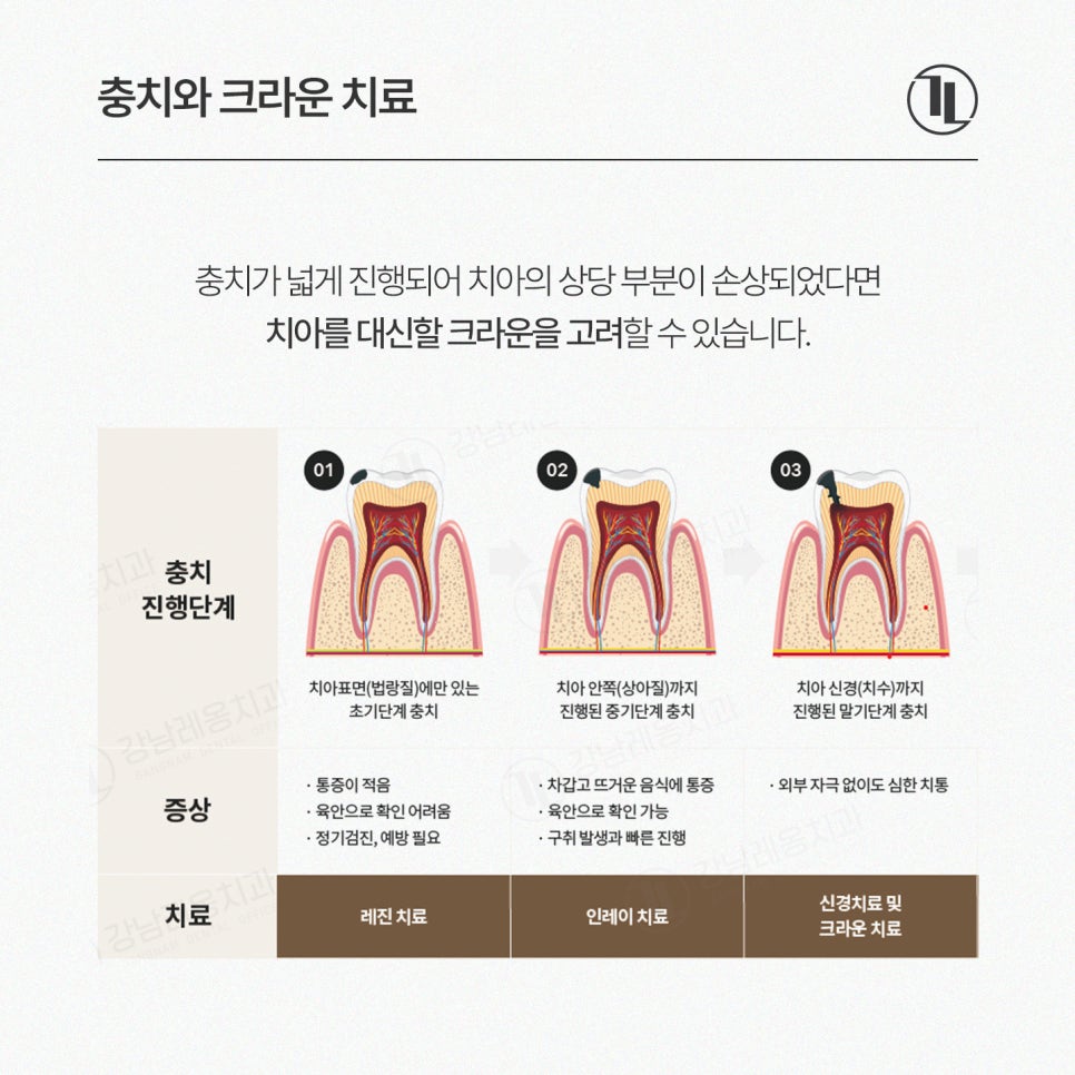 크라운 치료 가이드 / 충치&middot;신경치료 후 크라운과 가격&보험 / 강남레옹치과 관련 이미지 7