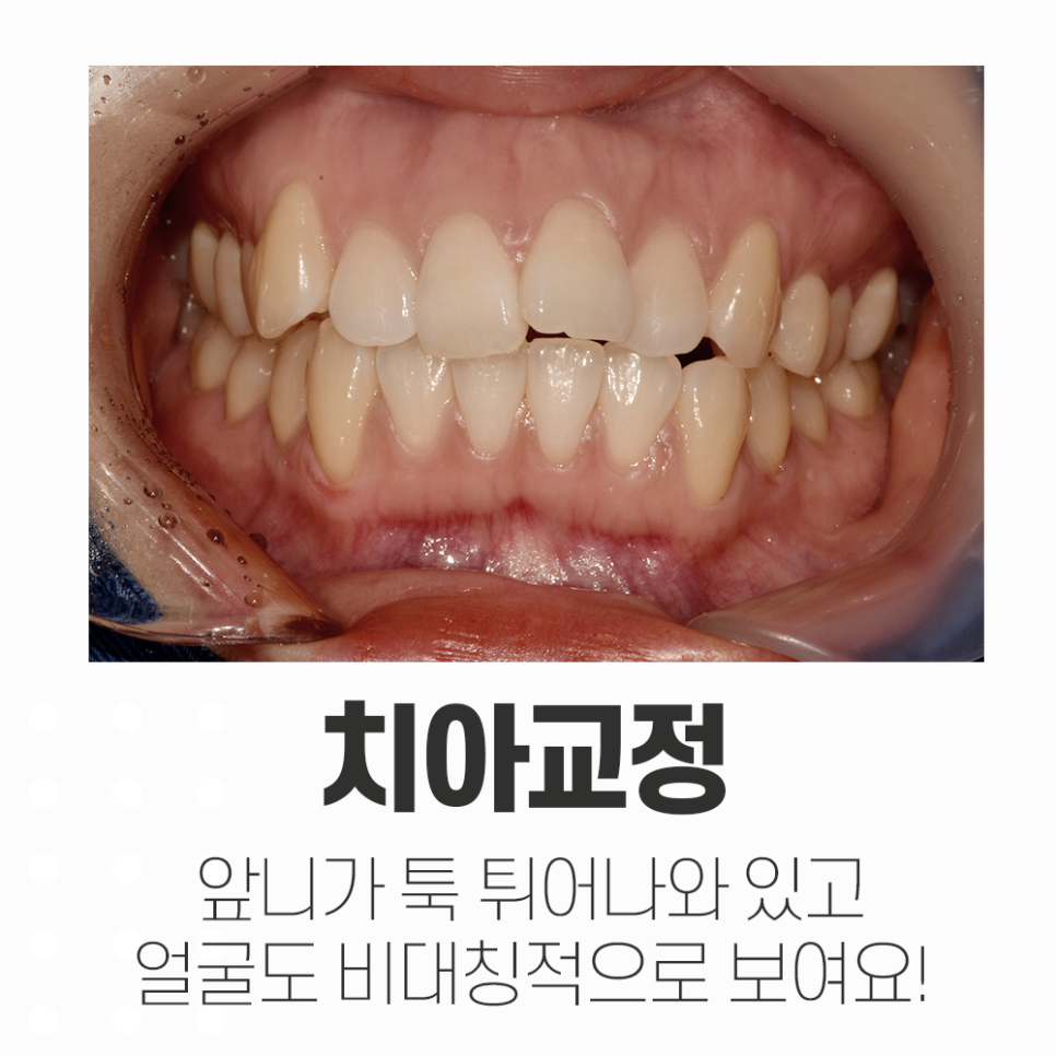 삐뚤빼뚤 앞니 비발치 교정, 옥니가 되지 않게 관련 이미지 1