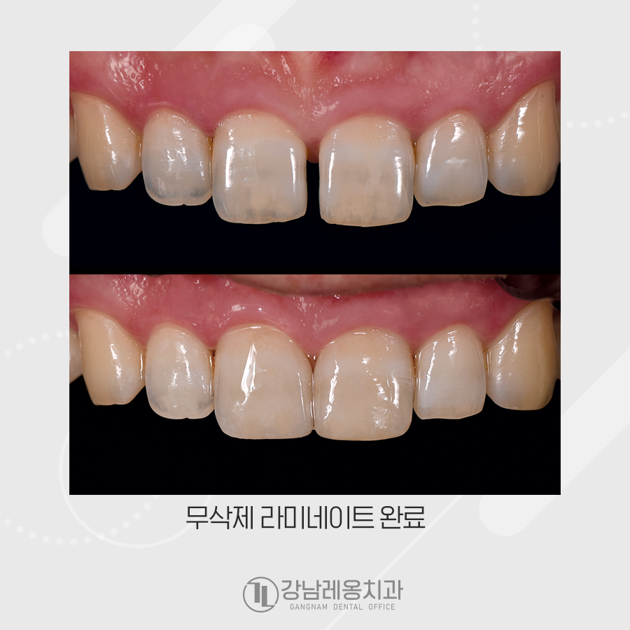 앞니 벌어짐 무삭제 라미네이트 치료는 장단점 꼭 확인! 관련 이미지 6