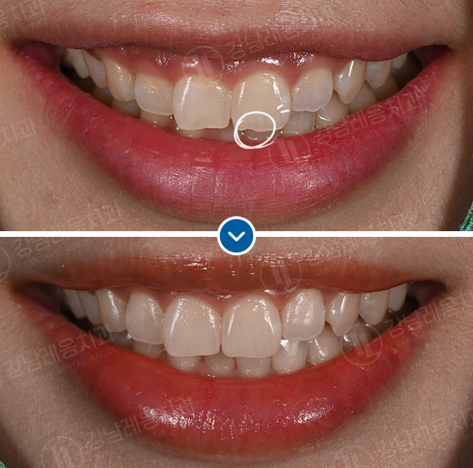 뉴티스 잇몸성형✨ 거미스마일 원인과 해결법, 잇몸성형으로 가능한가요? / 강남레옹치과 관련 이미지 2