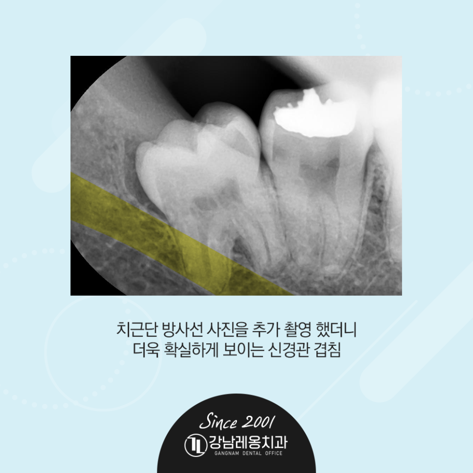 강남레옹치과 사랑니 발치! 통증 붓기 없이 2개를 한번에 뽑은 사례 관련 이미지 4