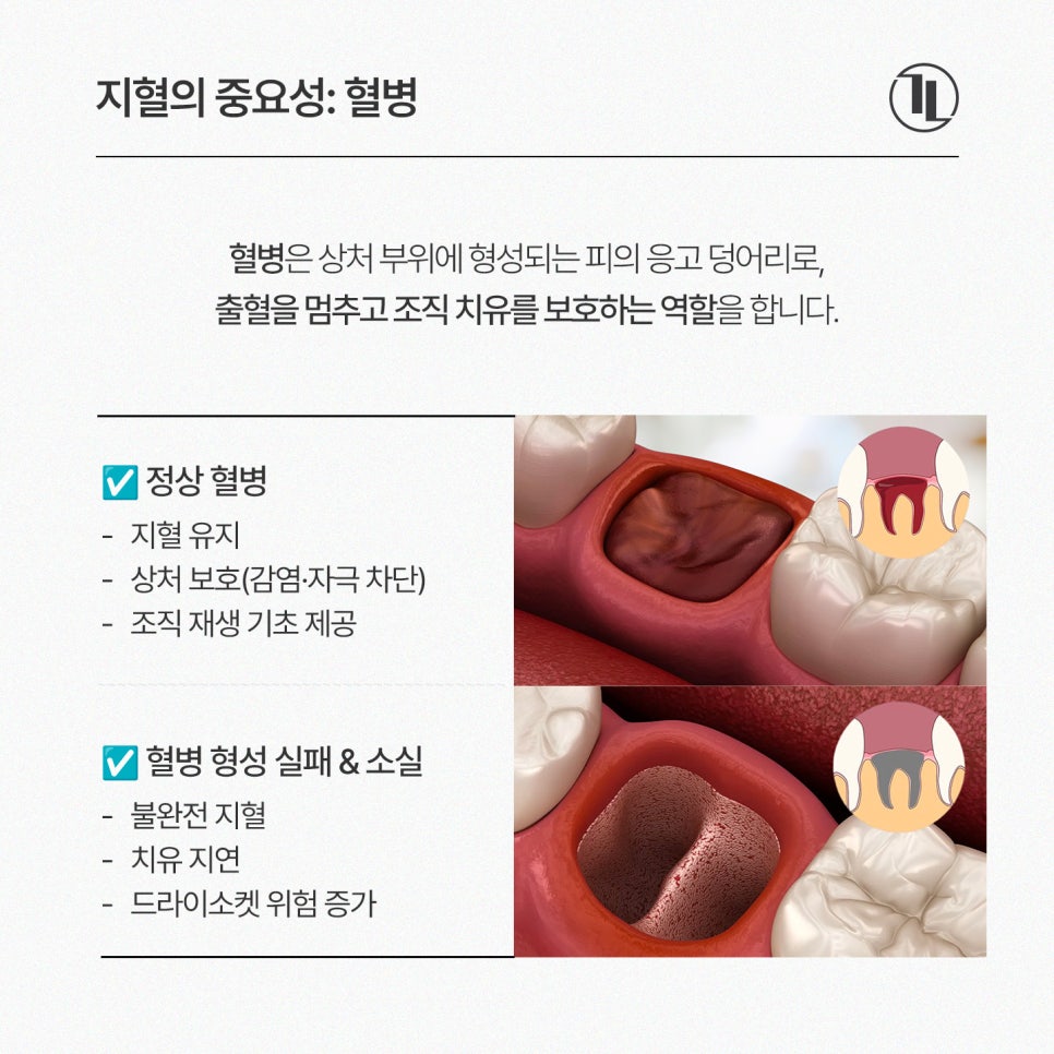 Is a Hemostatic Agent Really Necessary for Wisdom Tooth Extraction? Hemostatic Agent Usage Criteria, Insurance Coverage, and Cost / Gangnam Leon Dental Clinic image 4