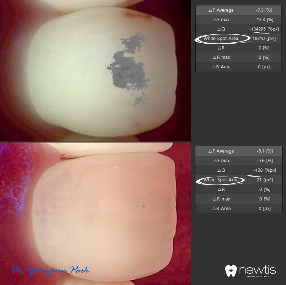 앞니 하얀얼룩 아이콘레진으로 말끔하게 / 뉴티스 반점치치료 / 강남레옹치과 관련 이미지 3