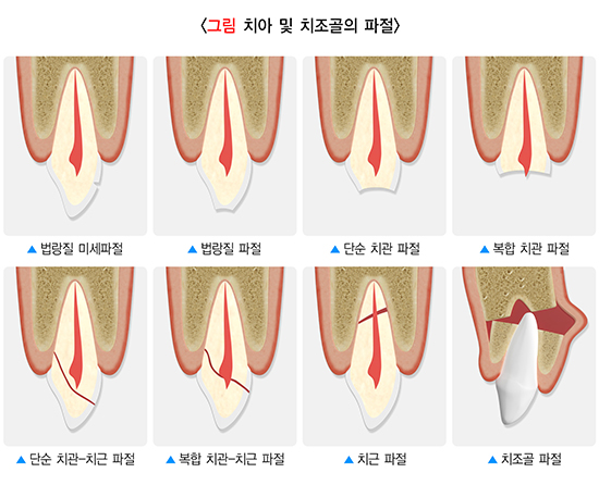 여름 휴가철, 안면외상 주의! 부딪혀서 앞니 흔들림 / 치아가 깨지거나 부러지면 제일 먼저 해야할 대처법은? / 치아 파절과 탈구 비교 관련 이미지 3