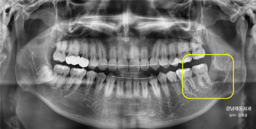 뿌리를 남긴 사랑니 발치? / 강남역 사랑니발치 강남레옹치과 관련 이미지 6