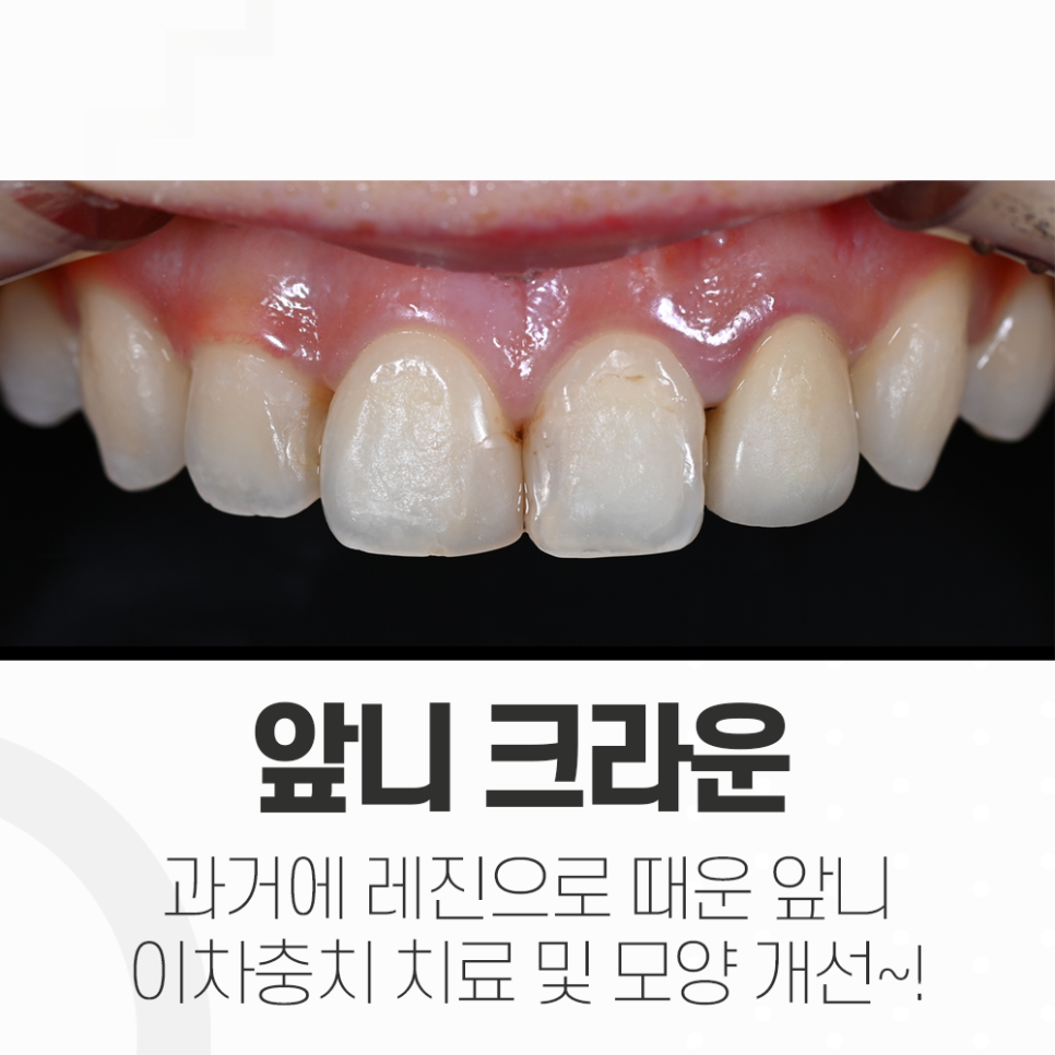 오래된 레진 교체 앞니 크라운! 강남레옹치과의 오랄디자인으로 개선 관련 이미지 1
