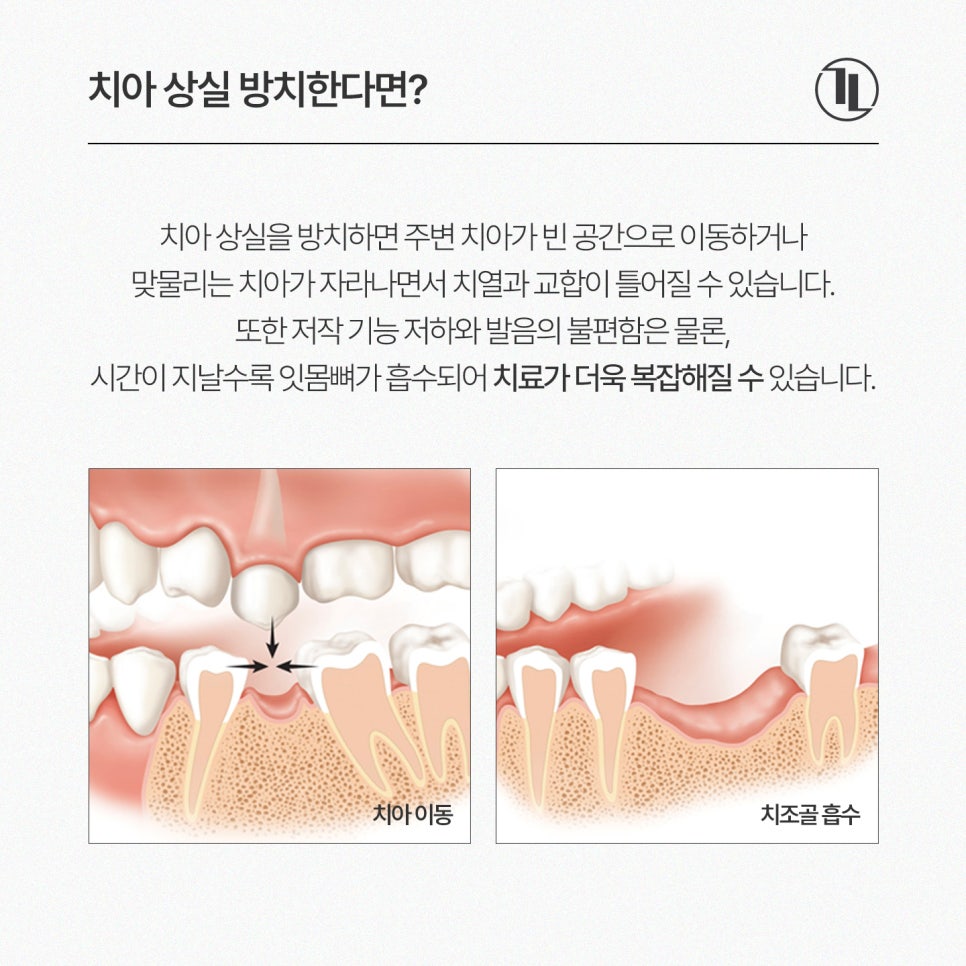Lost a Front Tooth? Comparing Maryland Bridges, Traditional Bridges, and Implants / Gangnam Leon Dental Clinic image 3