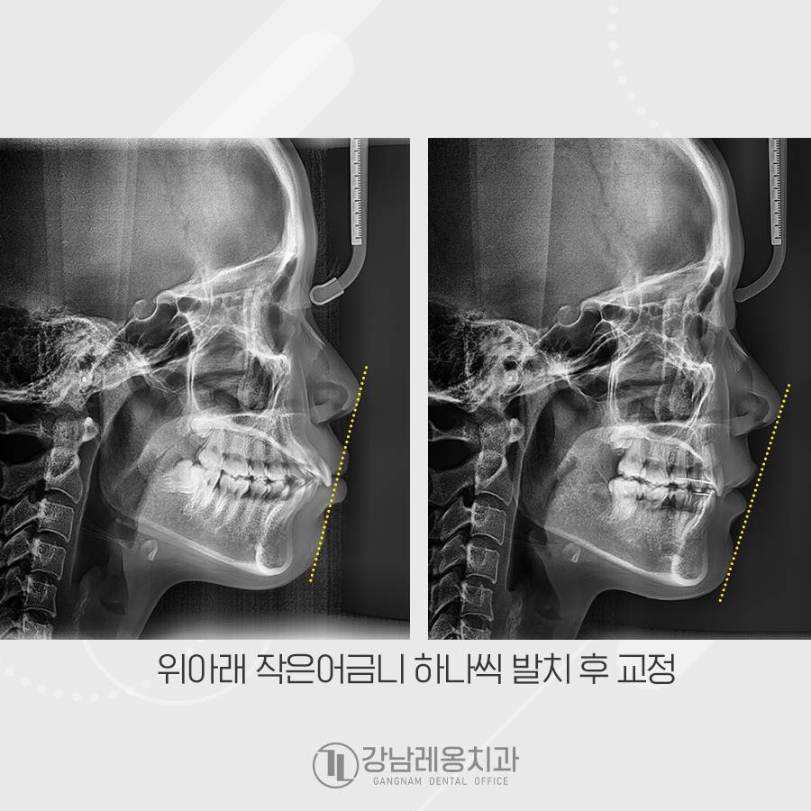 강남레옹치과 치아 교정, 돌출입 두가지 케이스 관련 이미지 7