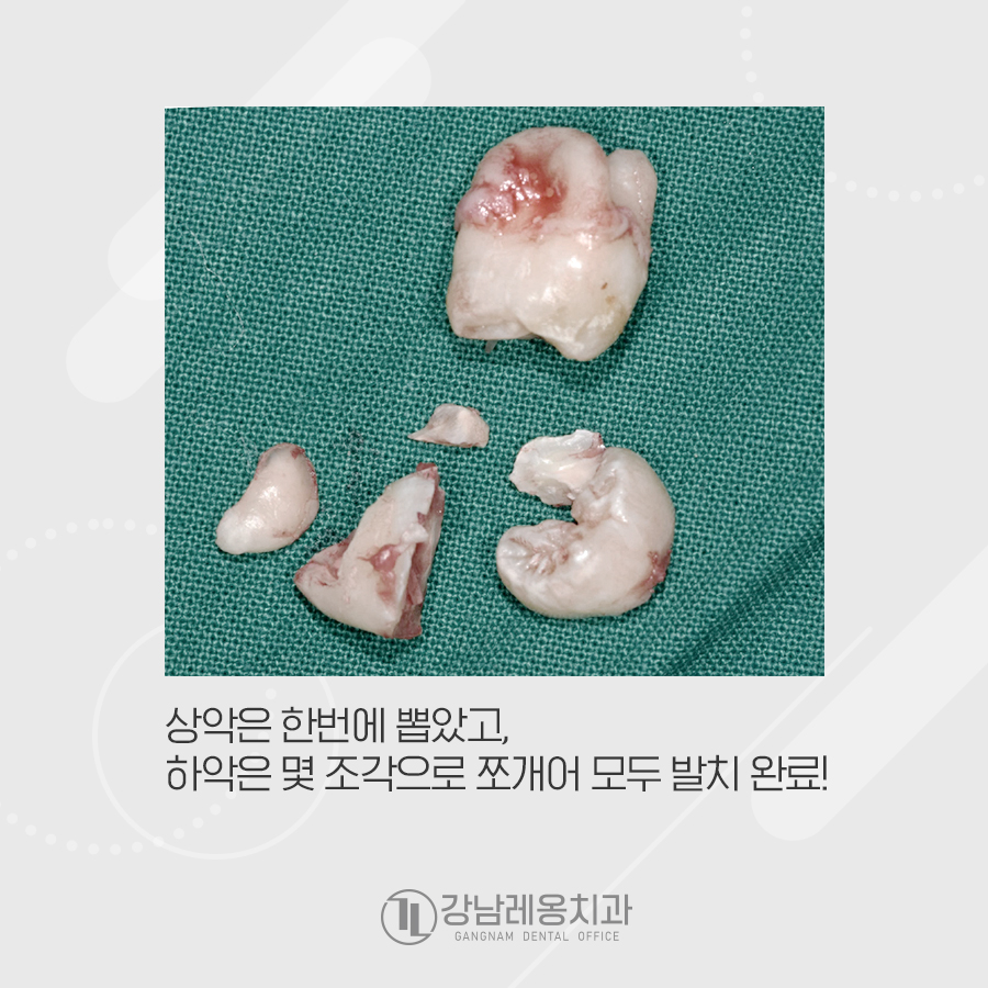 강남레옹치과 위아래 2개 사랑니발치 시간, 가격? 당일 가능? 관련 이미지 3