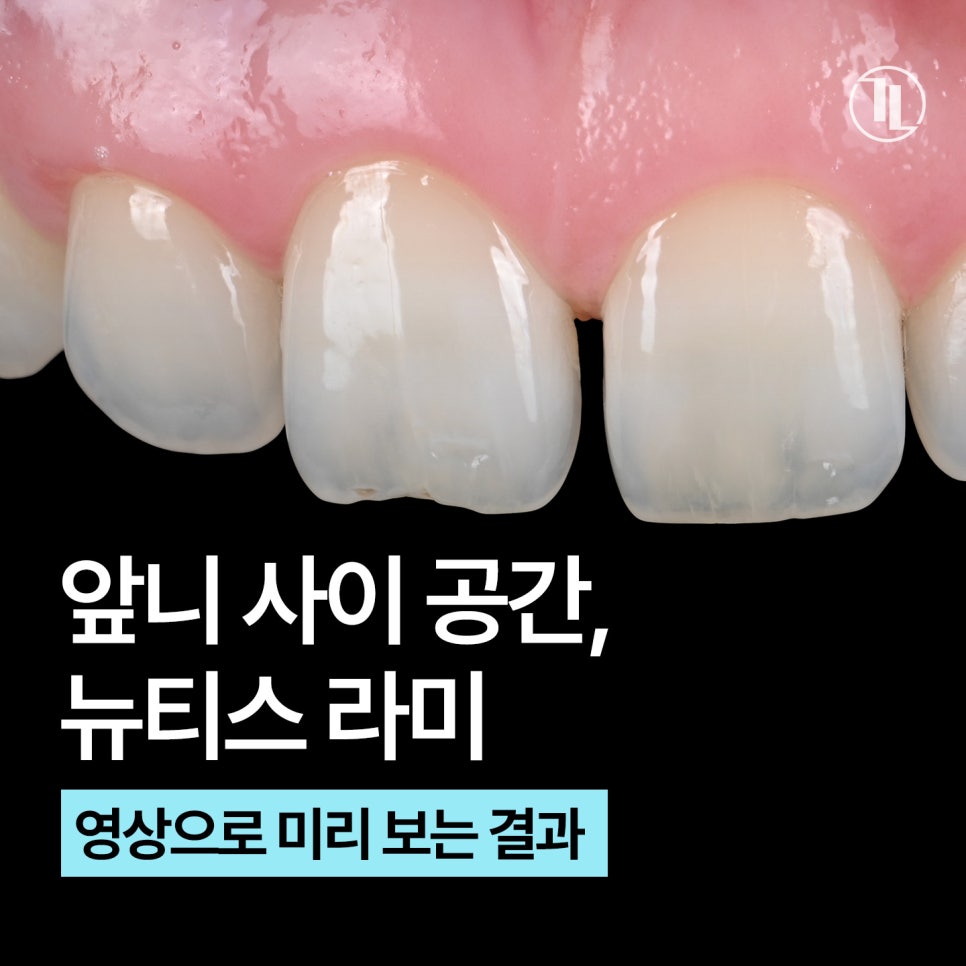 앞니 벌어짐, 정중이개 뉴티스라미 / 강남레옹치과 뉴티스 스마일 시뮬레이션 관련 이미지 1