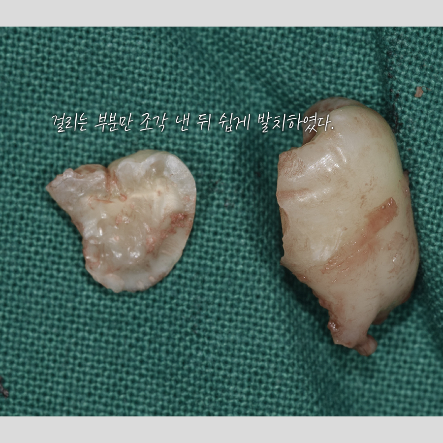 사랑니 발치 전문 레옹의 치료사례, 신경이 가깝거나 멀거나 관련 이미지 3