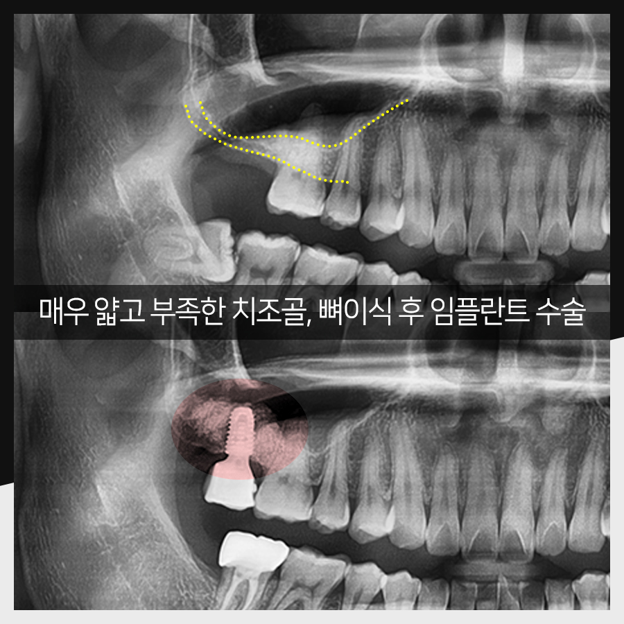 강남레옹치과 임플란트 수술 증례 한눈에 보기, 명불허전! 관련 이미지 3
