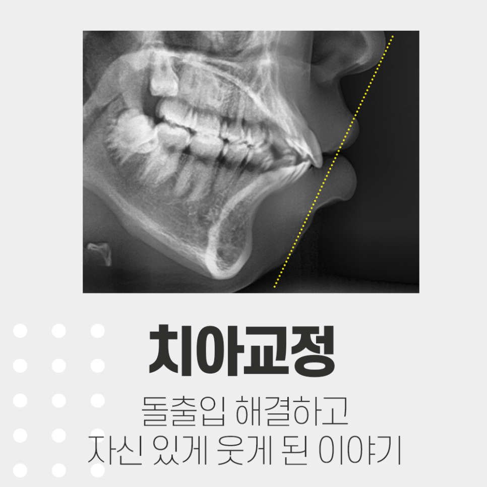 돌출입, 치아교정으로 심미라인에 맞춰 예쁘게 완성 관련 이미지 1