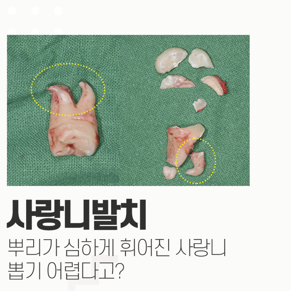 만곡치근? 뿌리가 휜 사랑니 4개 뽑아드린 발치 케이스 관련 이미지 1