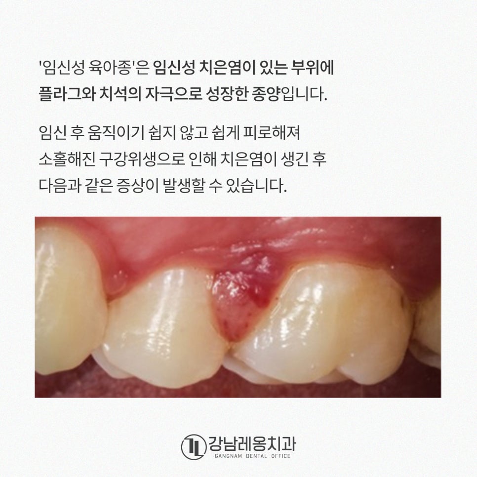 임산부 출산 후 치아관리, 잇몸관리 하는 방법 / 강남레옹치과 관련 이미지 3