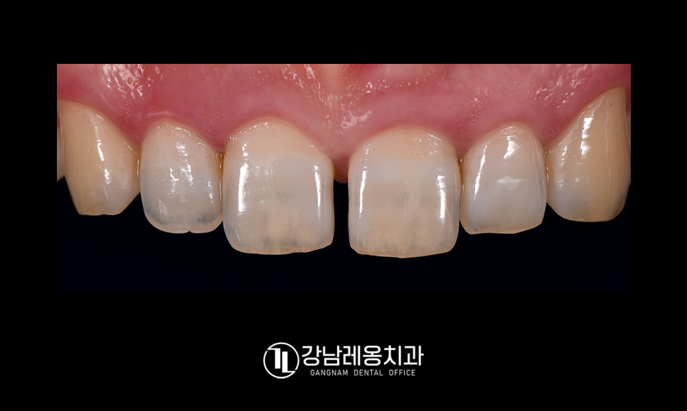 앞니 벌어짐 치료 후기 / 아이 앞니 벌어짐 건강하게 치료하려면? / 강남레옹치과 관련 이미지 2