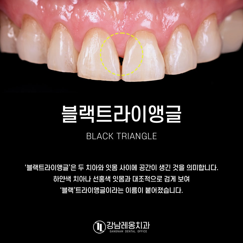 잇몸과 치아 사이 공간 &lsquo;블랙트라이앵글&rsquo;을 무시하면 안되는 이유! / 생기는 원인과 해결 방법 / 강남레옹치과 관련 이미지 1