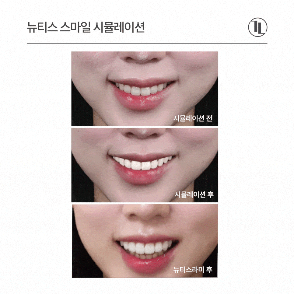 뉴티스 스마일 시뮬레이션 - 시술 전 영상으로 미리 확인하는 내 모습! / 강남레옹치과 관련 이미지 8