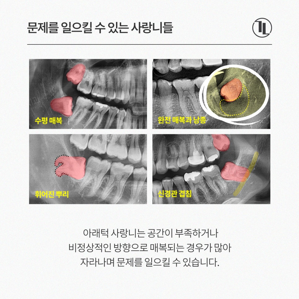 사랑니, 통증 없다고 그냥 둬도 될까? 사랑니의 3가지 사실 / 강남레옹치과 관련 이미지 3