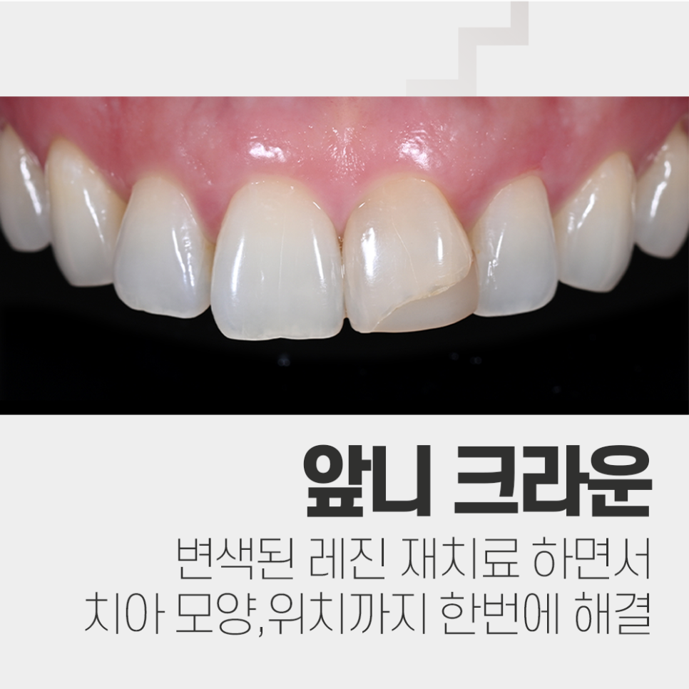 오래된 레진 변색, 강남레옹치과에서 앞니 크라운 치료 관련 이미지 1