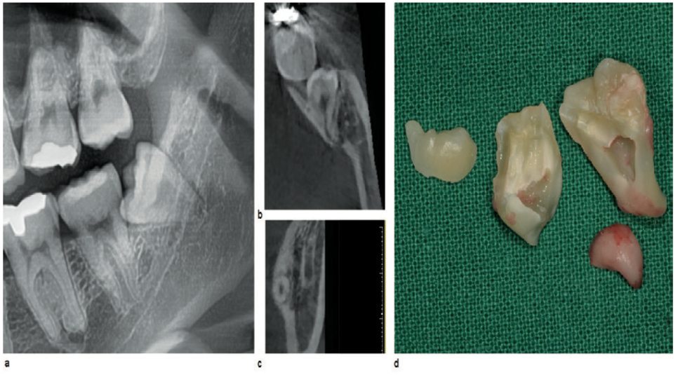 아래 매복 사랑니 발치 합병증에 관한 논문 연구! 박영민, 김영삼 원장님 관련 이미지 4