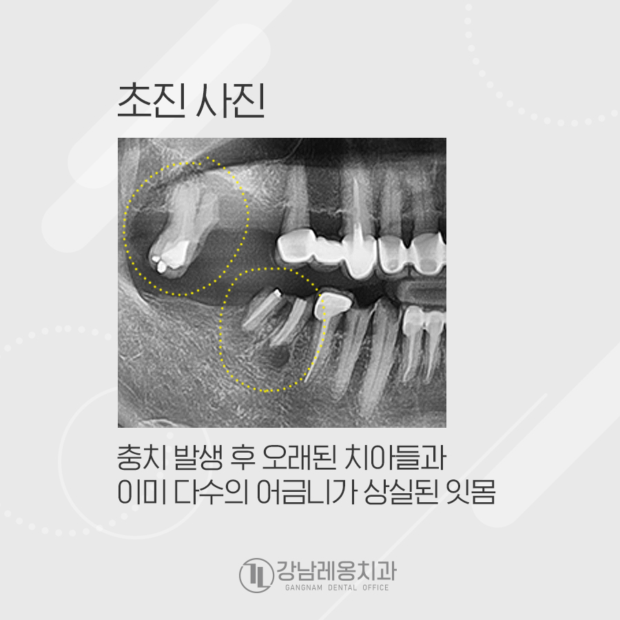어금니 충치 미루면 임플란트 수술 할 때 뼈이식도 관련 이미지 2