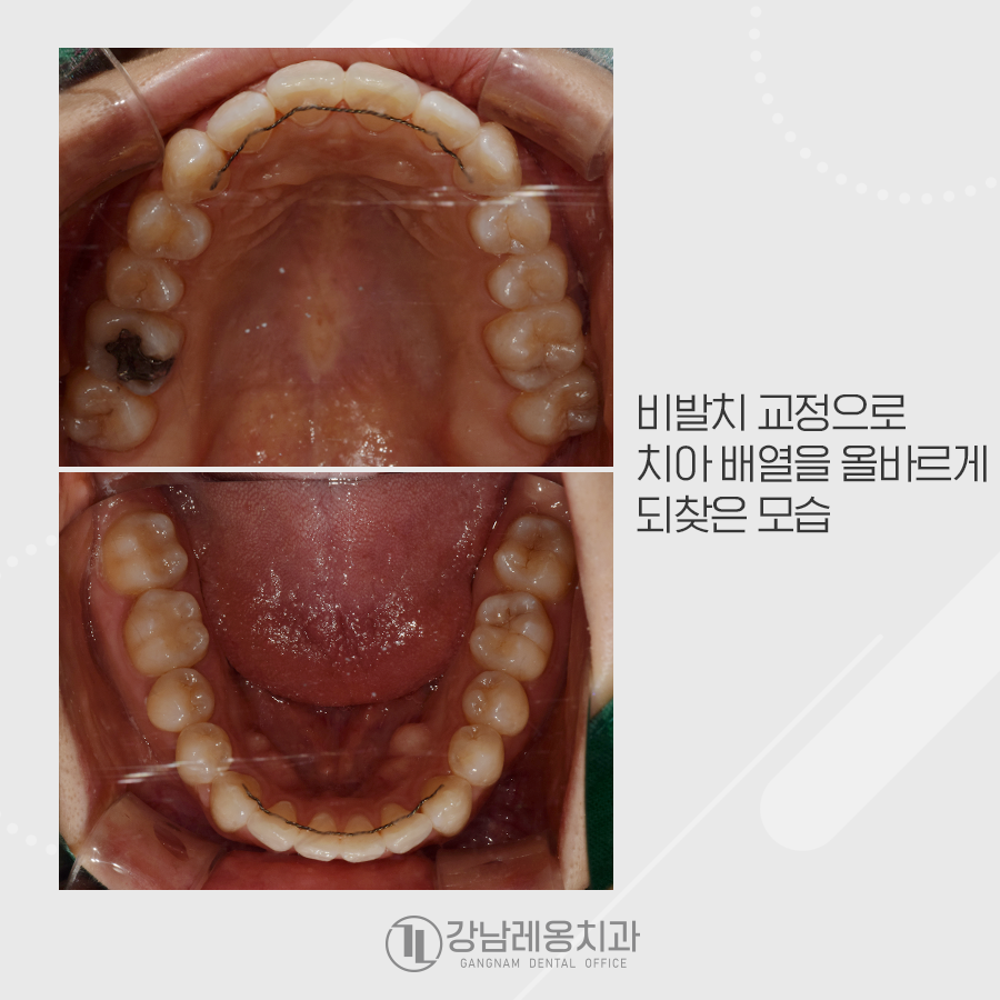 삐뚤빼뚤 앞니 비발치 교정, 옥니가 되지 않게 관련 이미지 4