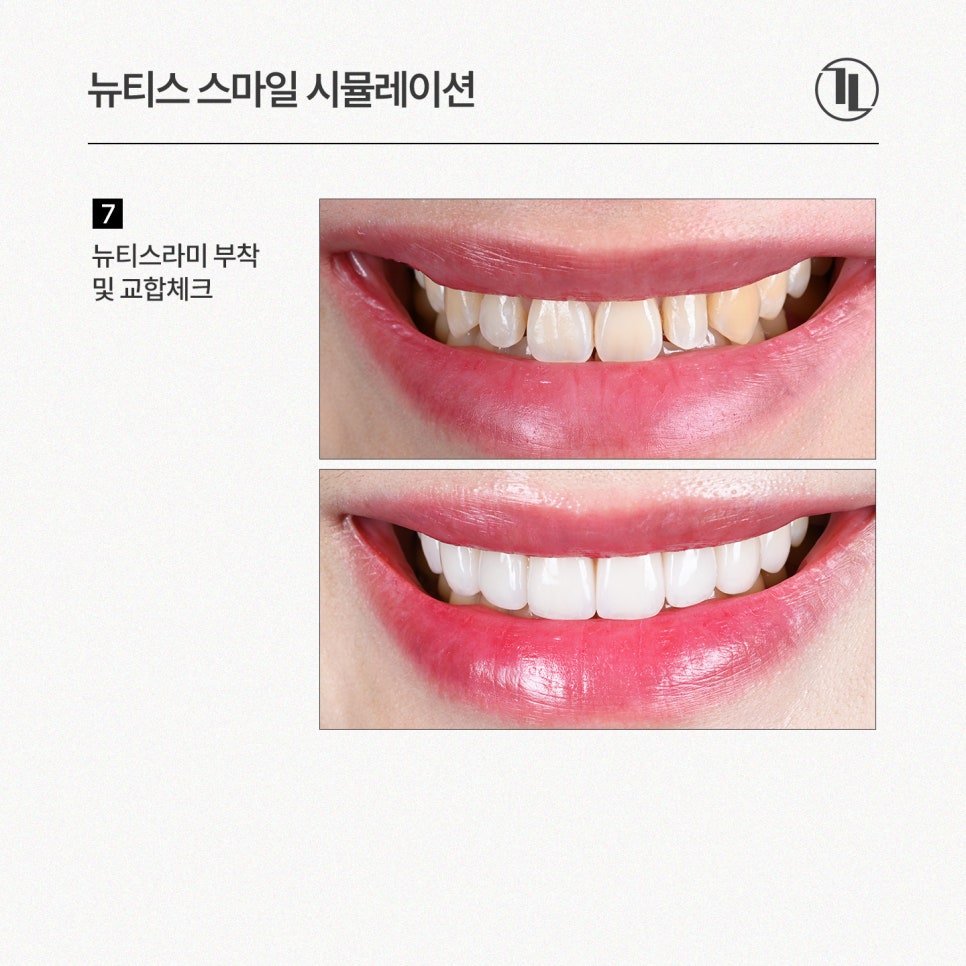 뉴티스 스마일 시뮬레이션 - 시술 전 영상으로 미리 확인하는 내 모습! / 강남레옹치과 관련 이미지 6