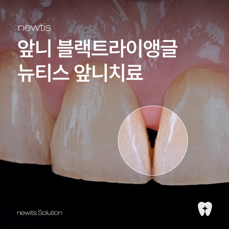앞니 공간 블랙 트라이앵글 개선, 강남레옹치과 앞니치료 뉴티스 관련 이미지 1