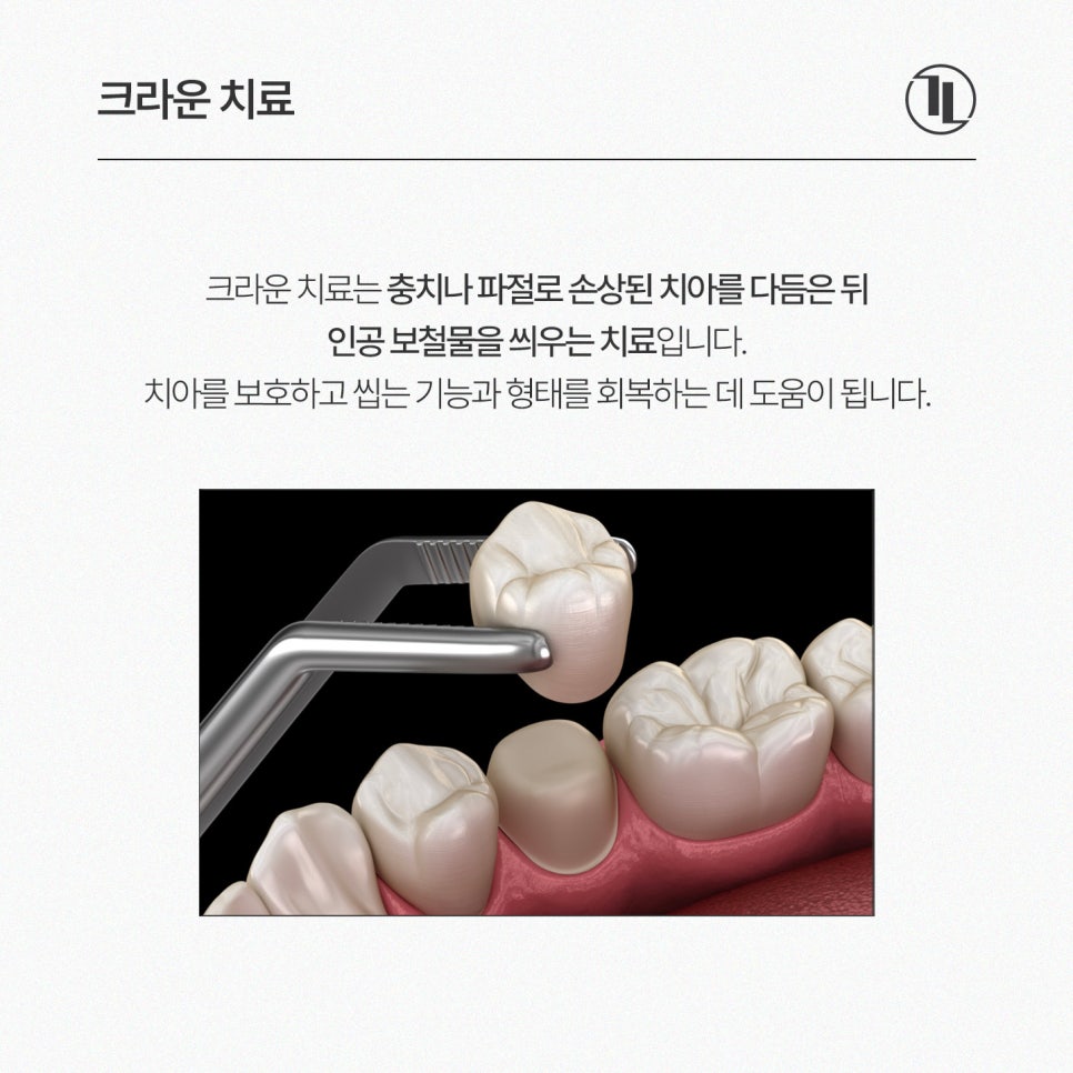 크라운 치료 가이드 / 충치&middot;신경치료 후 크라운과 가격&보험 / 강남레옹치과 관련 이미지 2