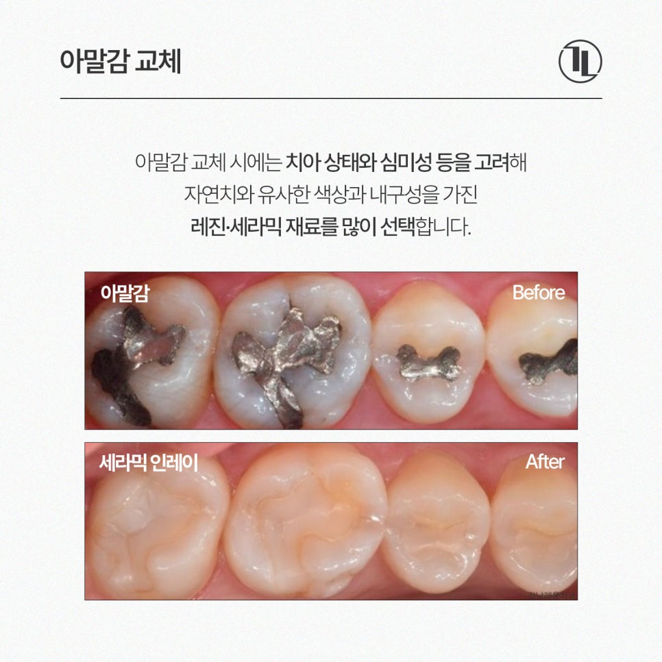 Should You Replace Dental Amalgam? Reasons and Necessity for Amalgam Replacement / Gangnam Leong Dental Clinic image 5