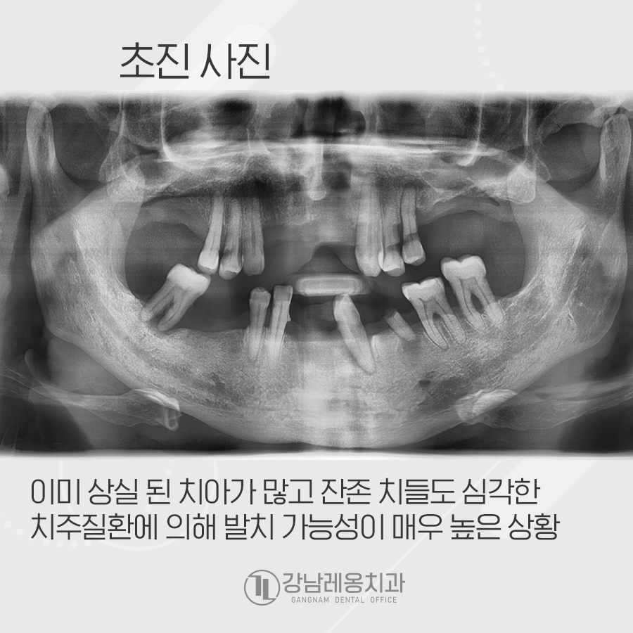 강남레옹치과 전악 임플란트 수술로 심미, 저작 기능을 회복해요. 관련 이미지 2