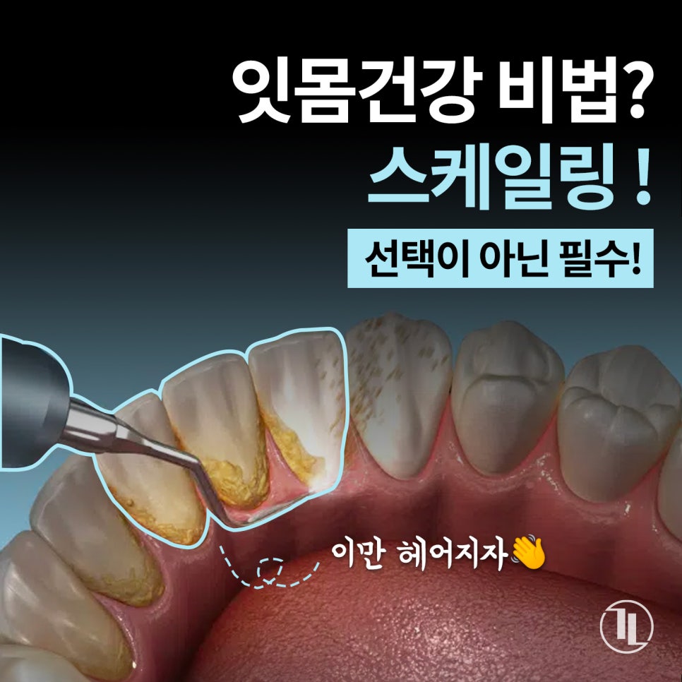 겨울철 구강관리, 스케일링 한 번으로 바뀌는 잇몸 상태❄️ / 강남레옹치과 관련 이미지 1
