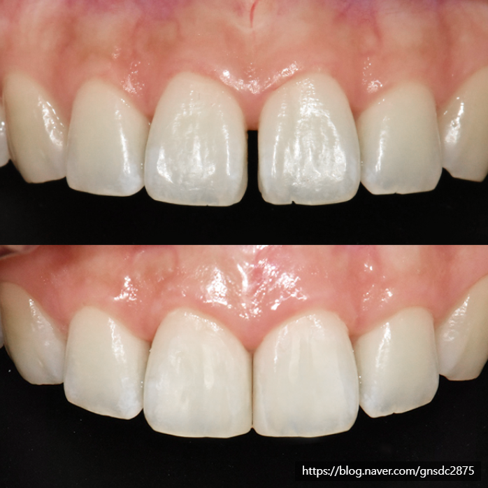 박영민 원장님의 뉴티스 앞니치료 세미나 in LA🤓 관련 이미지 6