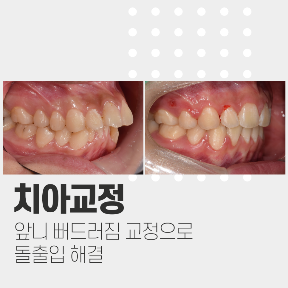 앞니 뻐드러짐 치아 교정으로 돌출입 들어간 케이스 관련 이미지 1